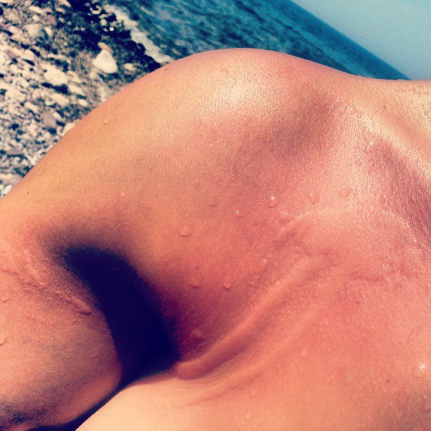 inflamed skin on chest from jellyfish sting