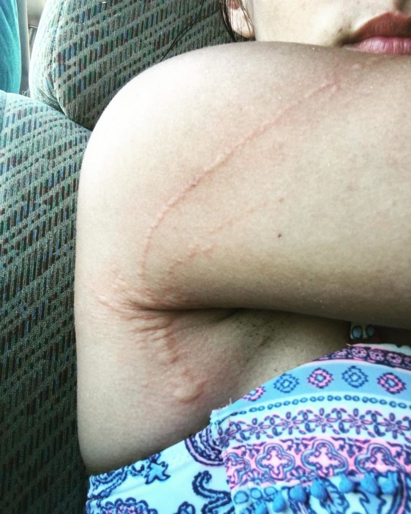 result of skin lesion after being stung by jellyfish on arm