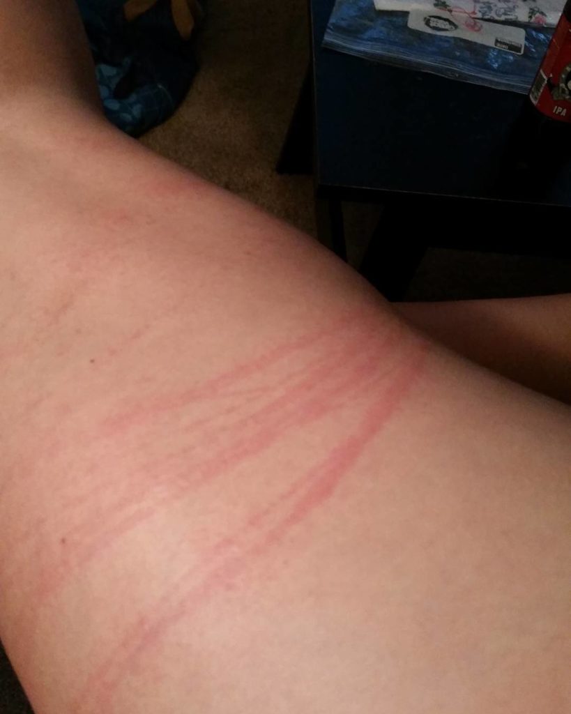 red line on leg from jellyfish stings