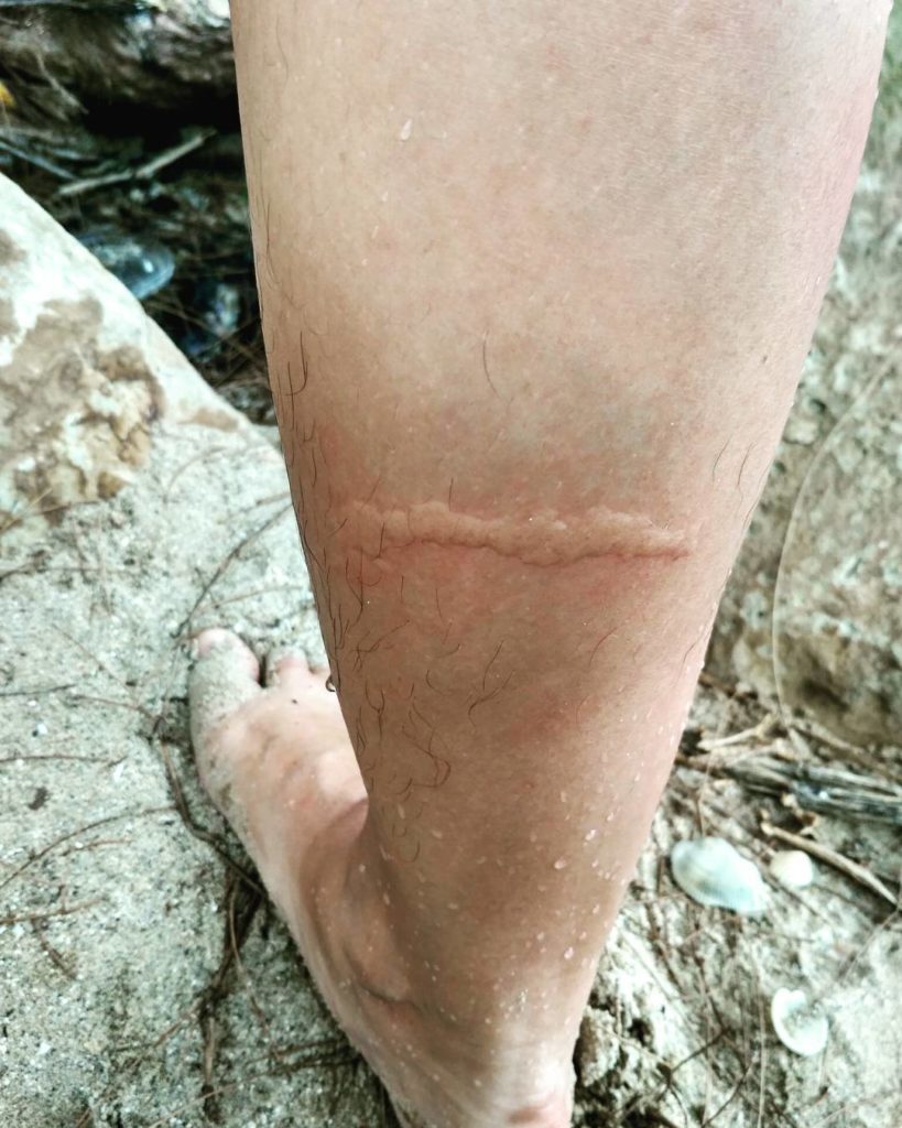 swollen raised bump on calf from jellyfish sting
