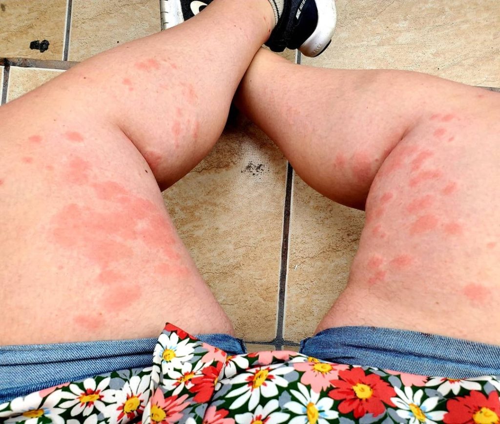 red irritated marks on legs from jellyfish stings