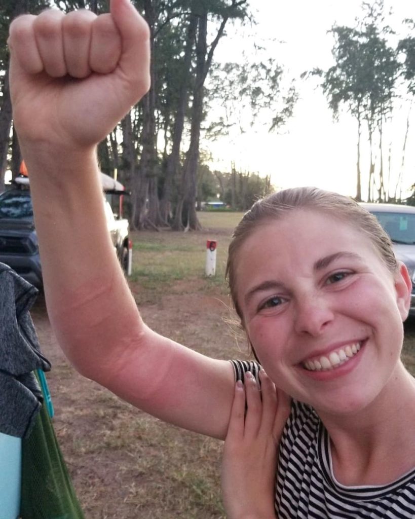 girl smiling as she hold her arm up to show swollen marks of jellyfish stings