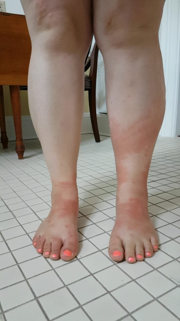 red marks on legs after being stung by jellyfish